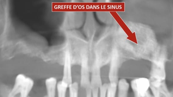 schéma d'un sinus lift