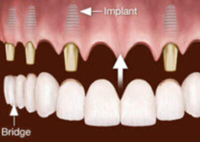 Schéma de bridge complet fixe sur implant