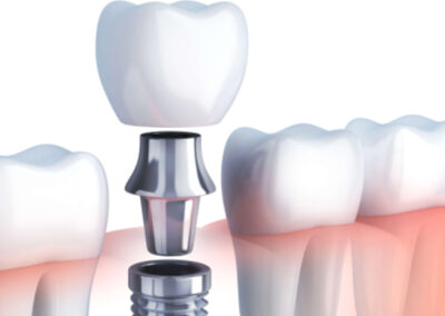 schéma d'une couronne unitaire fixe sur implant