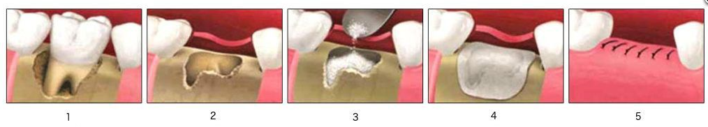 schema d'un comblement osseux post-extractionnel