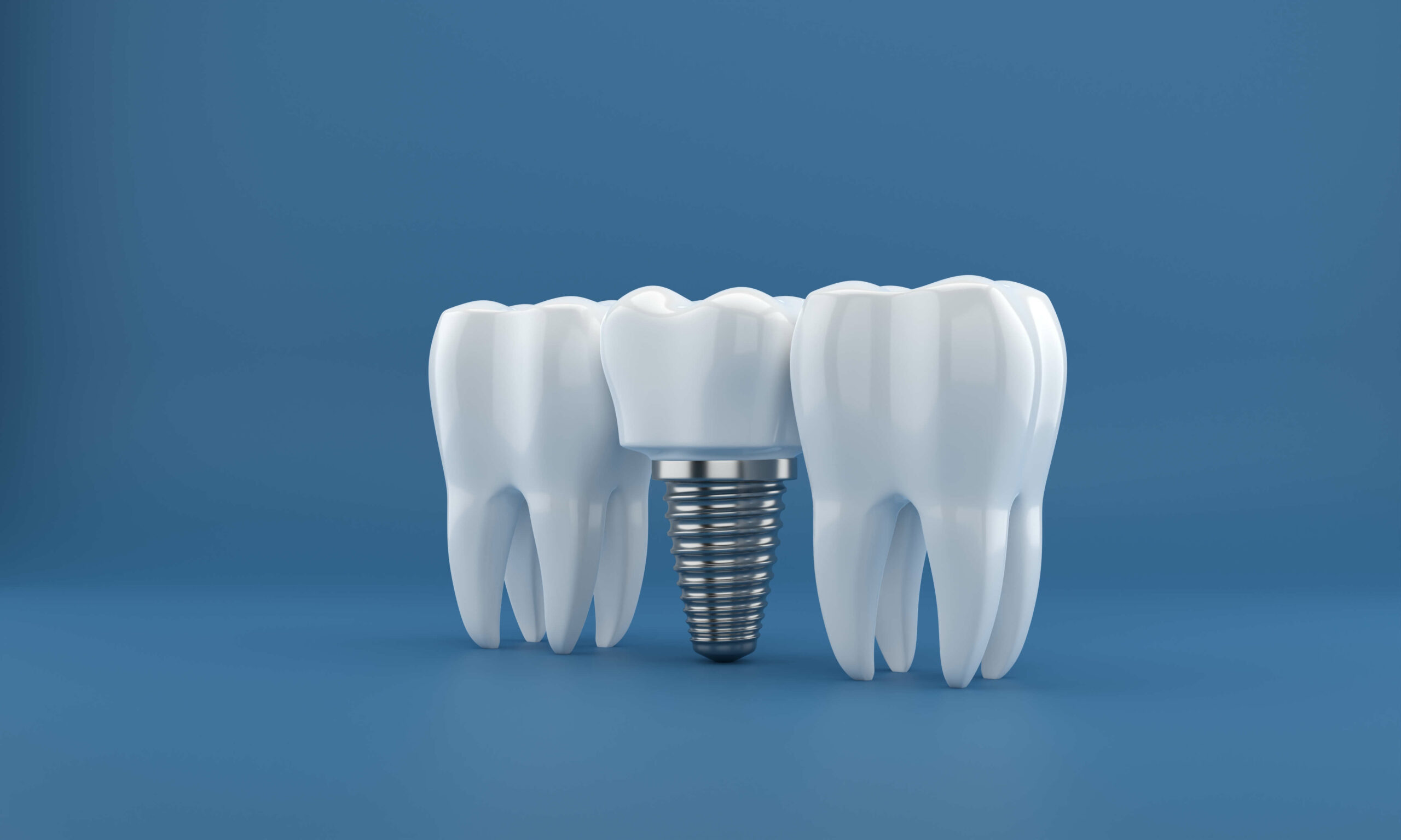 Implant dentaire en 3D