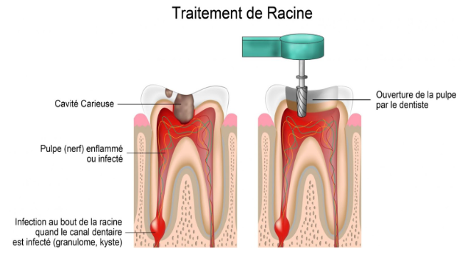 de quoi traite l'endodontie